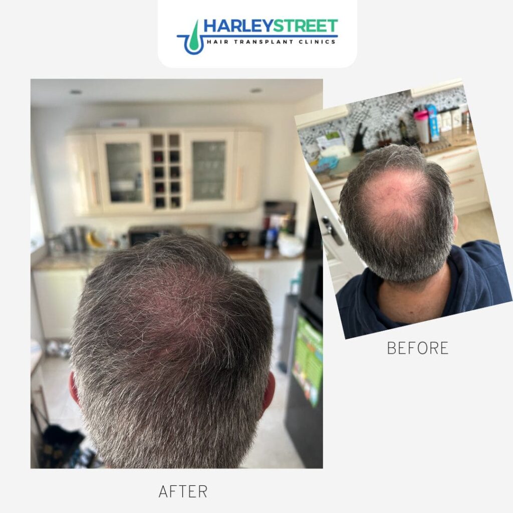 Crown Hair Transplant 1 Before and after crown ht chris h