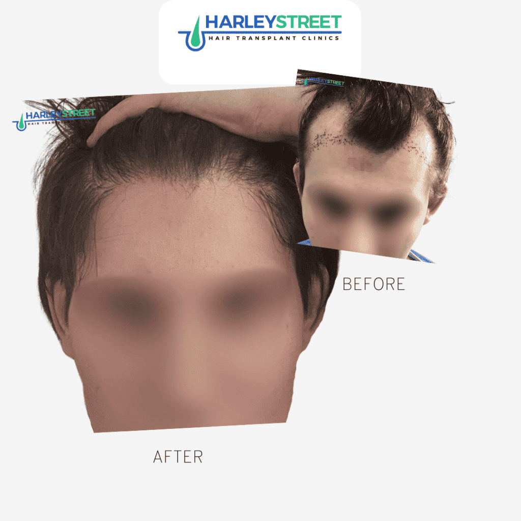 Charlotte Lloyd - before and after