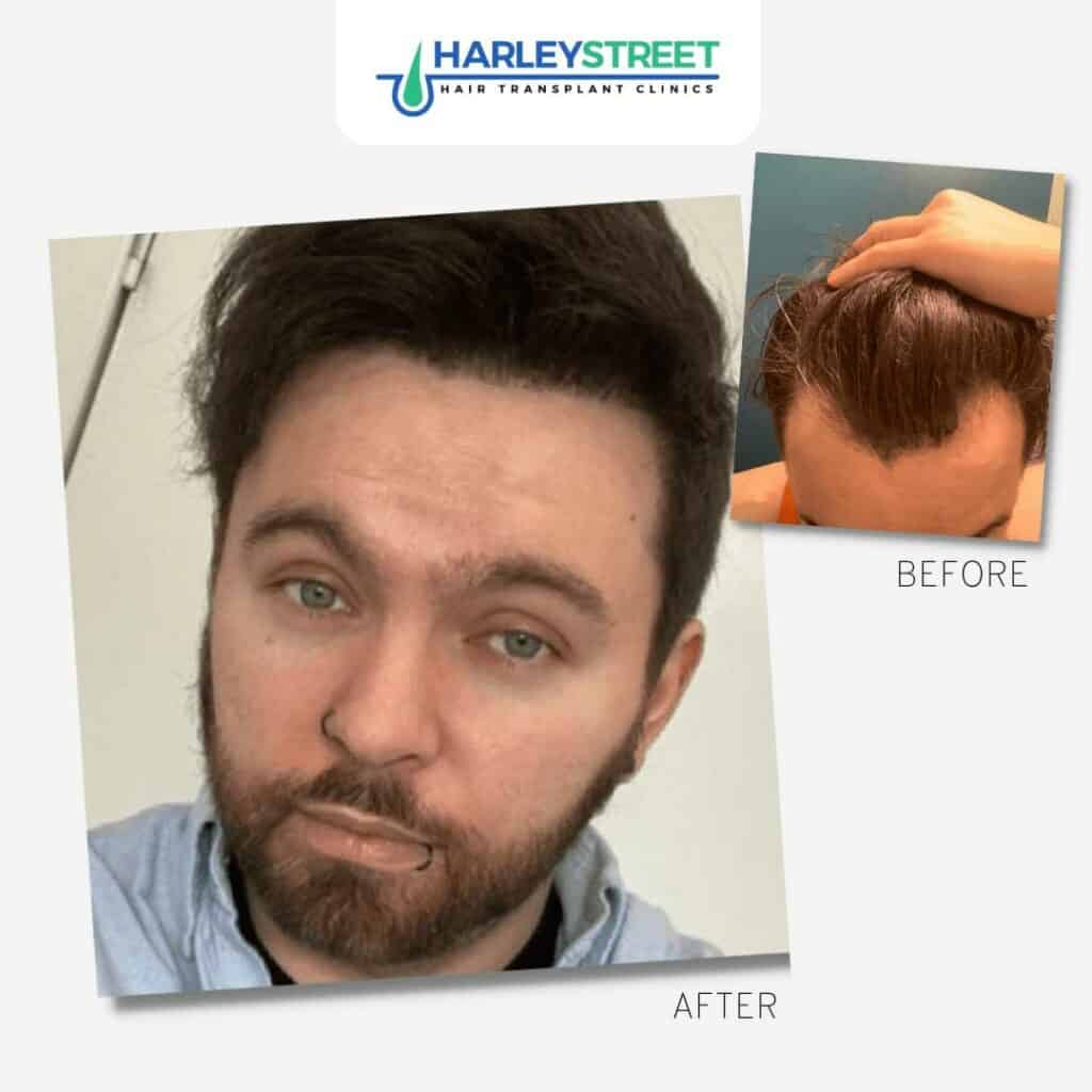 Hairline hair transplant