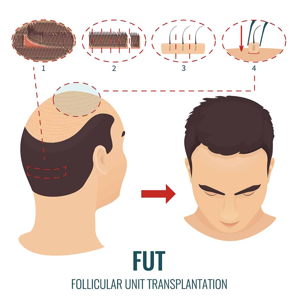 fut method image