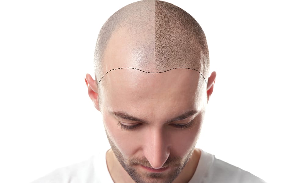 hair transplant cost and pricing image