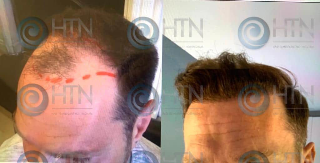 Hair-Transplant-Nottingham-client-before-and-after-surgery