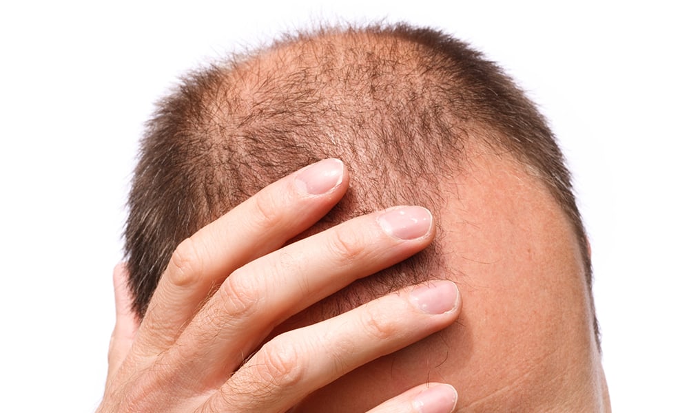 Male Pattern Baldness - What is it? - HTN